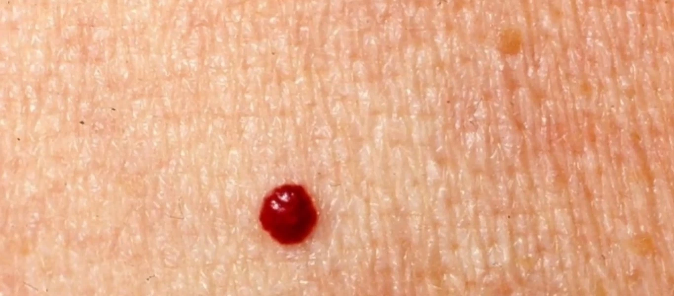 Κόκκινες ελιές στο δέρμα: Πότε εμφανίζονται και πότε θέλουν προσοχή (βίντεο)